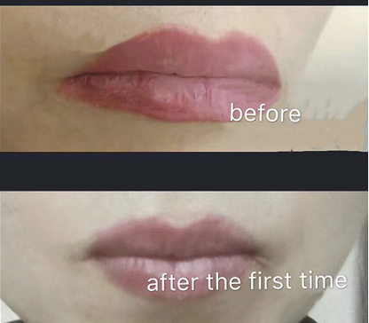 Lips Comaprison of before and after using YD Tattoo Remover