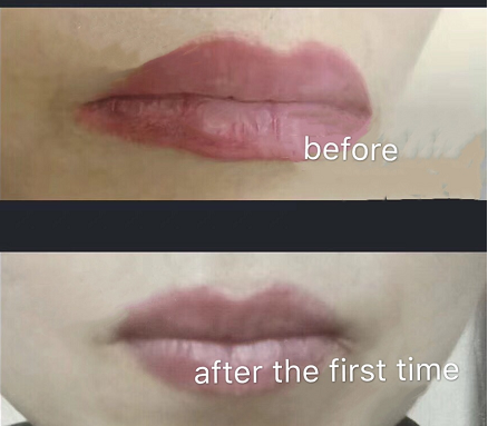 Lips Comaprison of before and after using YD Tattoo Remover