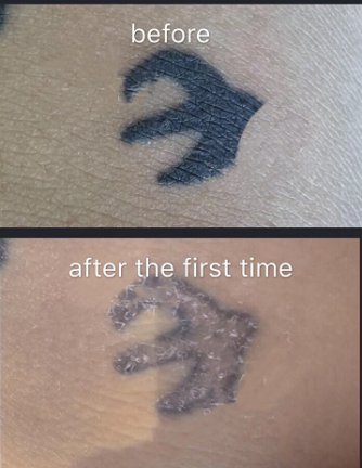 Tattoo Comaprison of before and after using YD Tattoo Remover