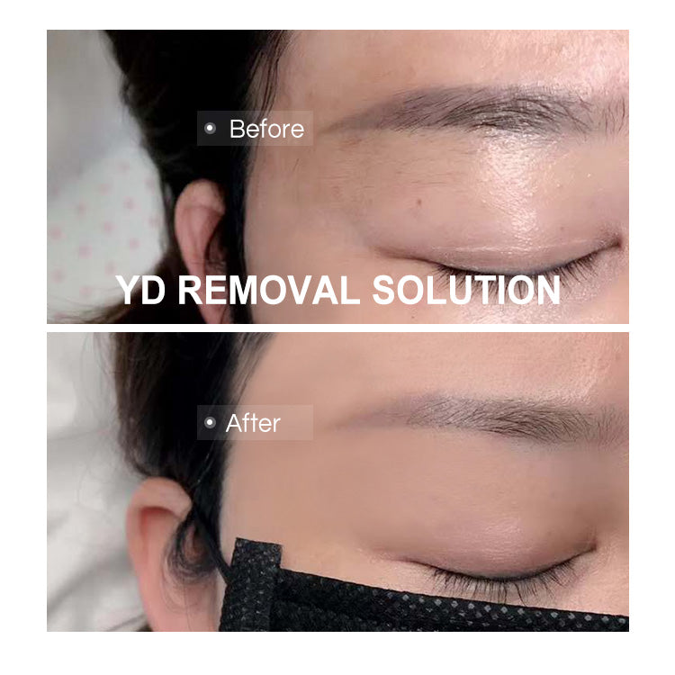 Eyebrows Comaprison of before and after using YD Tattoo Remover